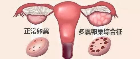美国试管婴儿：技术KO多囊卵巢综合征！